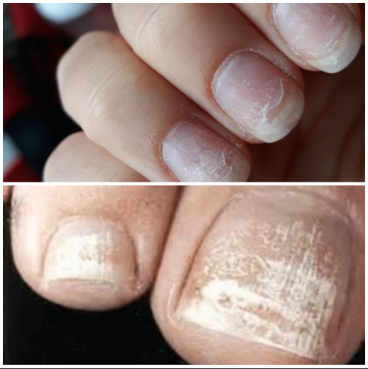 ugly nails