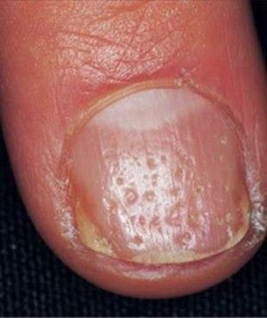 ugly nails