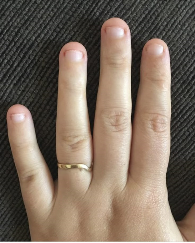 ugly nails