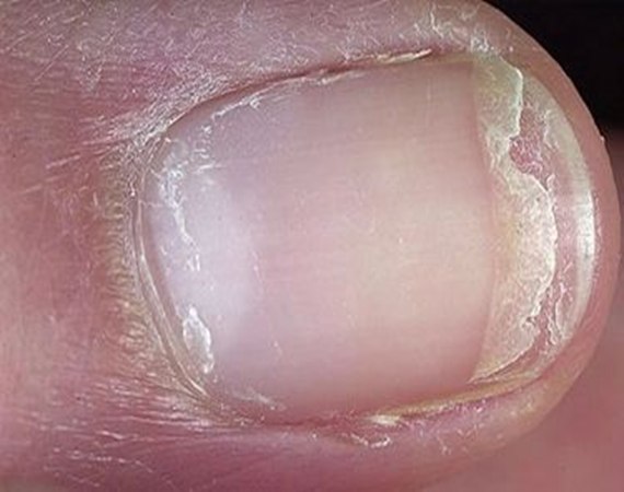 ugly nails