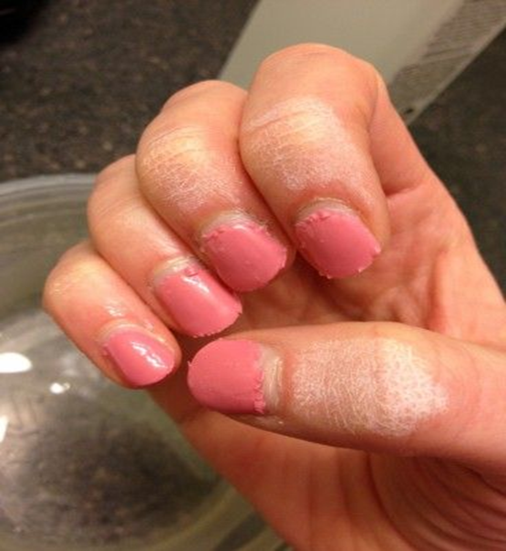 ugly nails